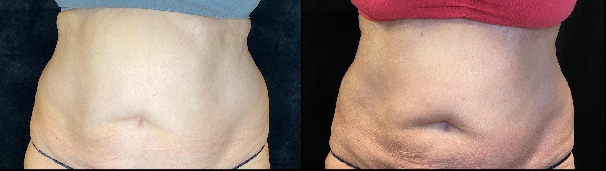 EvolveX Before & After Gallery - Patient 154143650 - Image 1