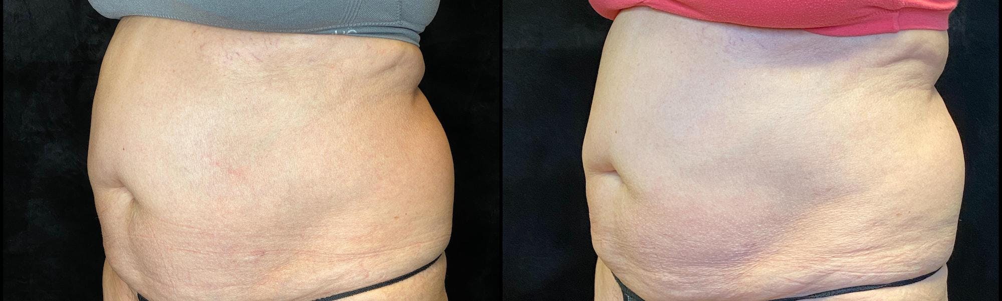 EvolveX Before & After Gallery - Patient 154143650 - Image 2