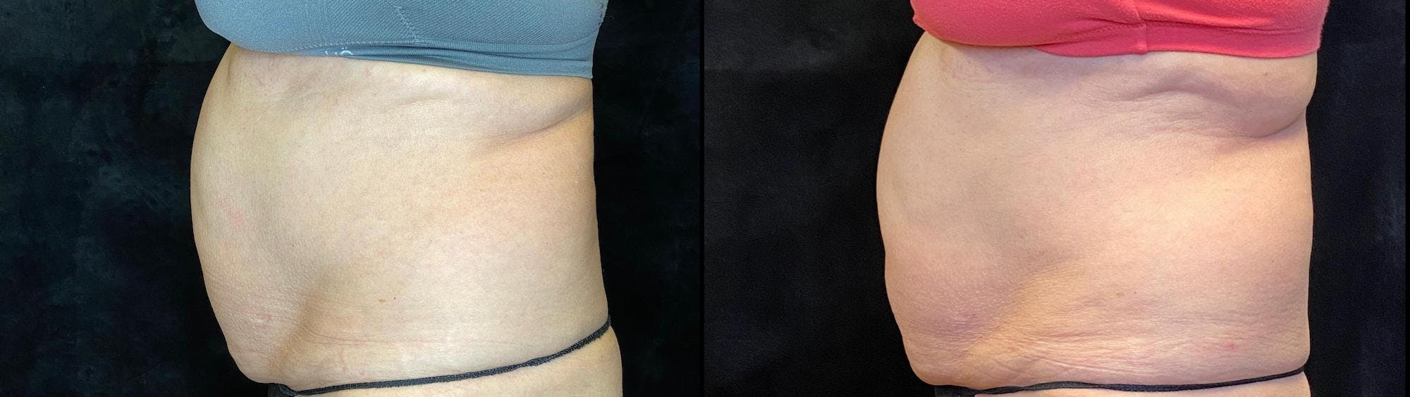 EvolveX Before & After Gallery - Patient 154143650 - Image 3