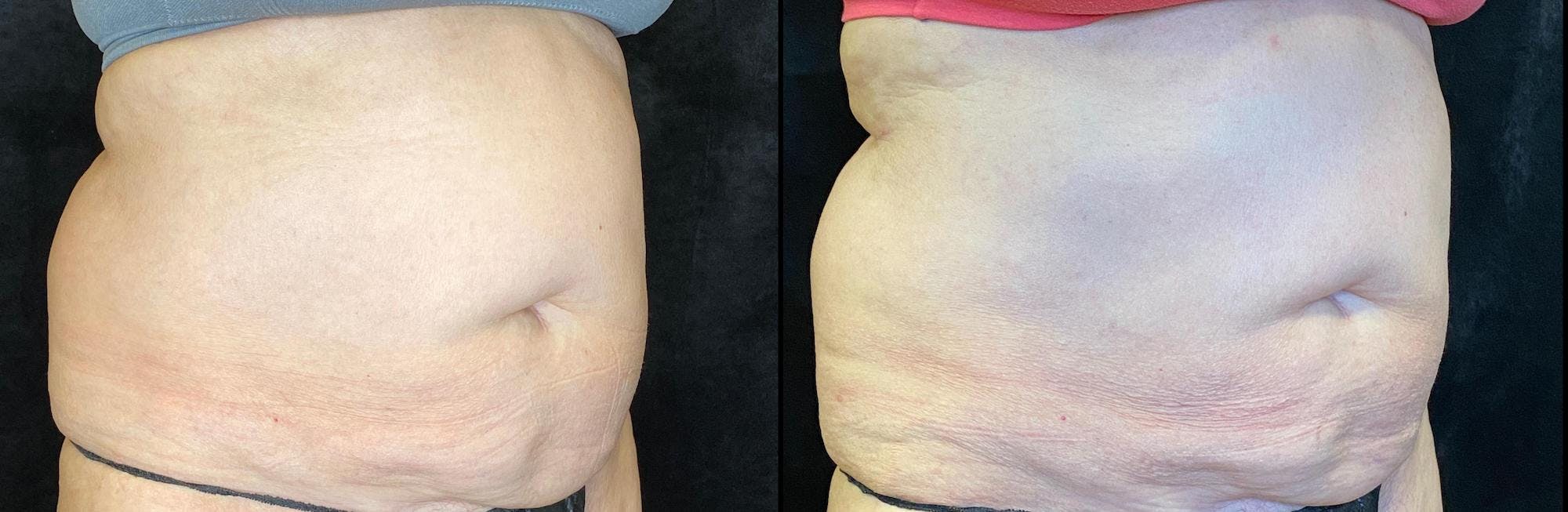 EvolveX Before & After Gallery - Patient 154143650 - Image 4