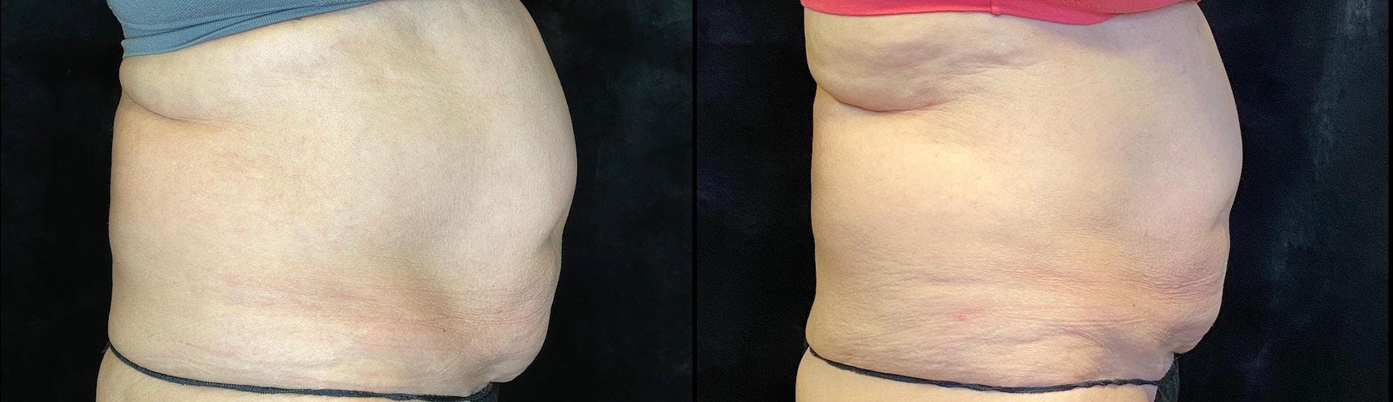 EvolveX Before & After Gallery - Patient 154143650 - Image 5