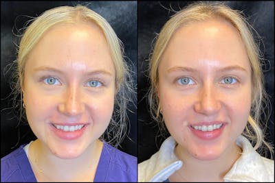 BOTOX/Dysport Before & After Gallery - Patient 63592171 - Image 1