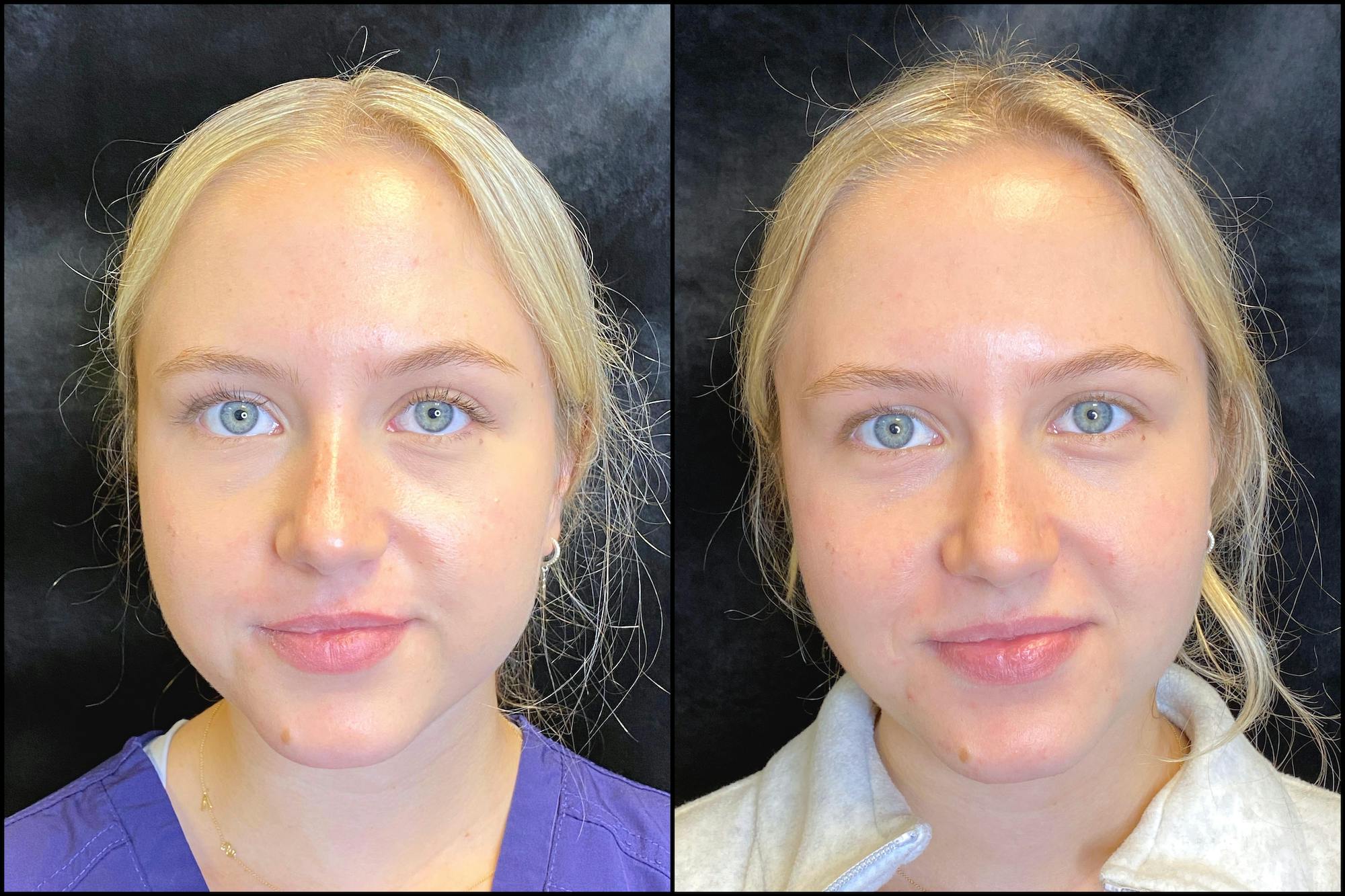 BOTOX/Dysport Before & After Gallery - Patient 63592171 - Image 4