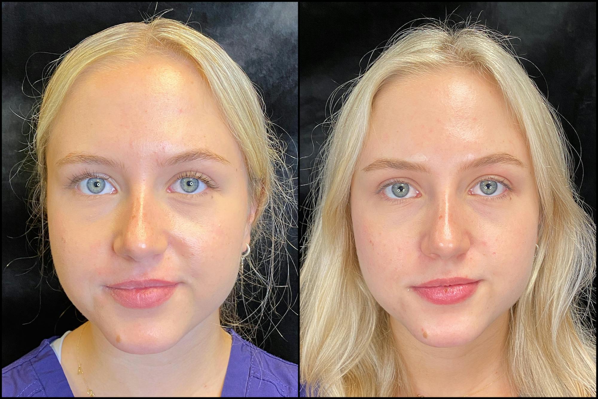 BOTOX/Dysport Before & After Gallery - Patient 63592171 - Image 3