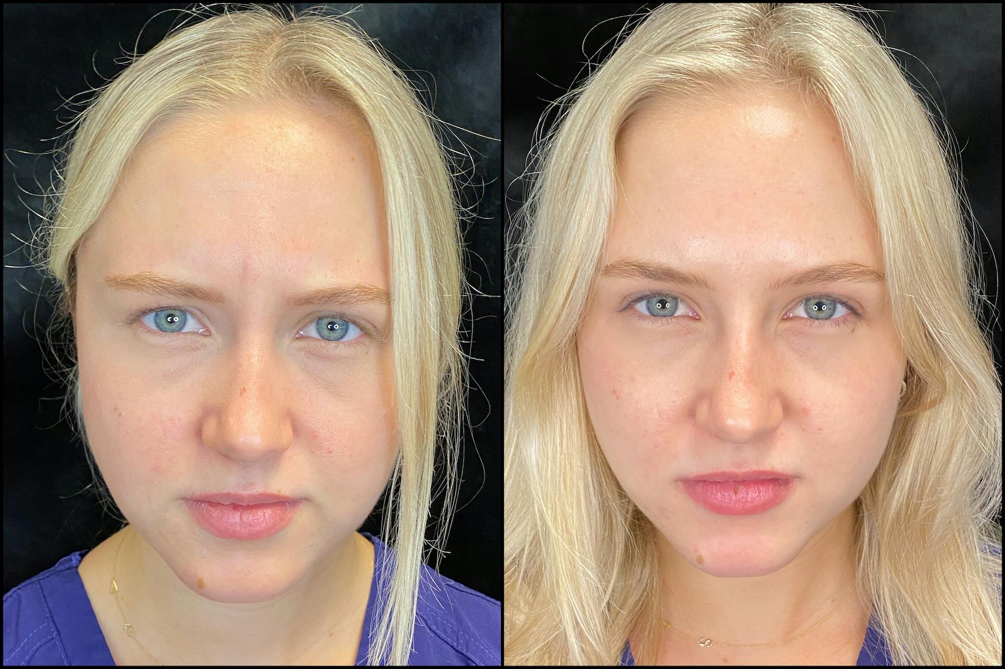 Before & after Botox in Austin at Modern Women's Health