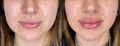 Dermal Fillers Before & After Gallery - Patient 79763737 - Image 1