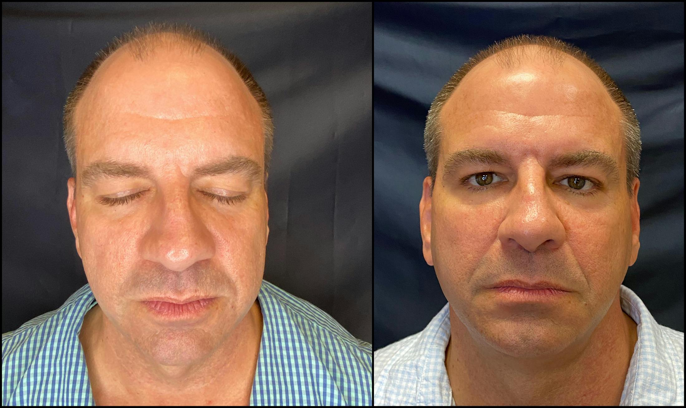 Dermal Fillers Before & After Gallery - Patient 79766325 - Image 1