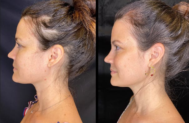 Morpheus8 Before & After Gallery - Patient 68195332 - Image 3