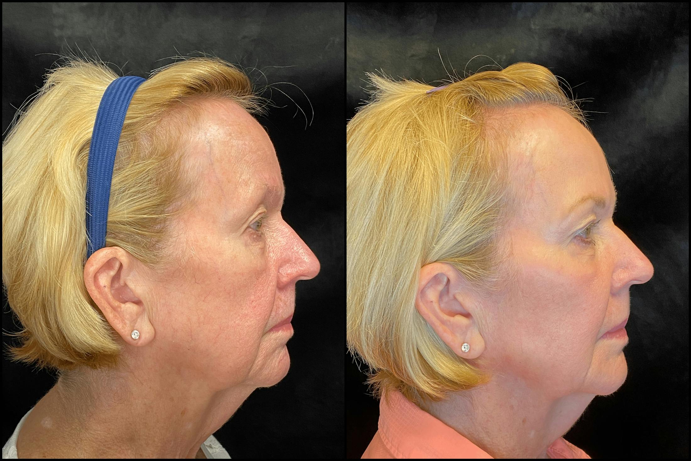 BOTOX/Dysport Before & After Gallery - Patient 79766576 - Image 5