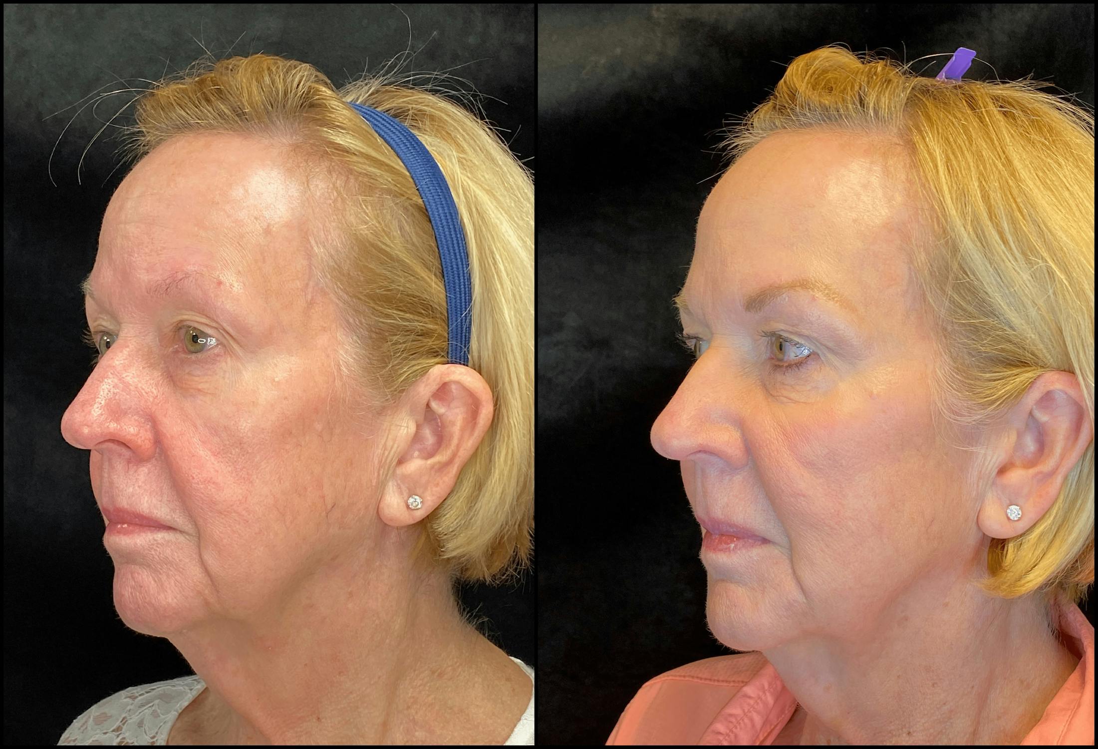 BOTOX/Dysport Before & After Gallery - Patient 79766576 - Image 2