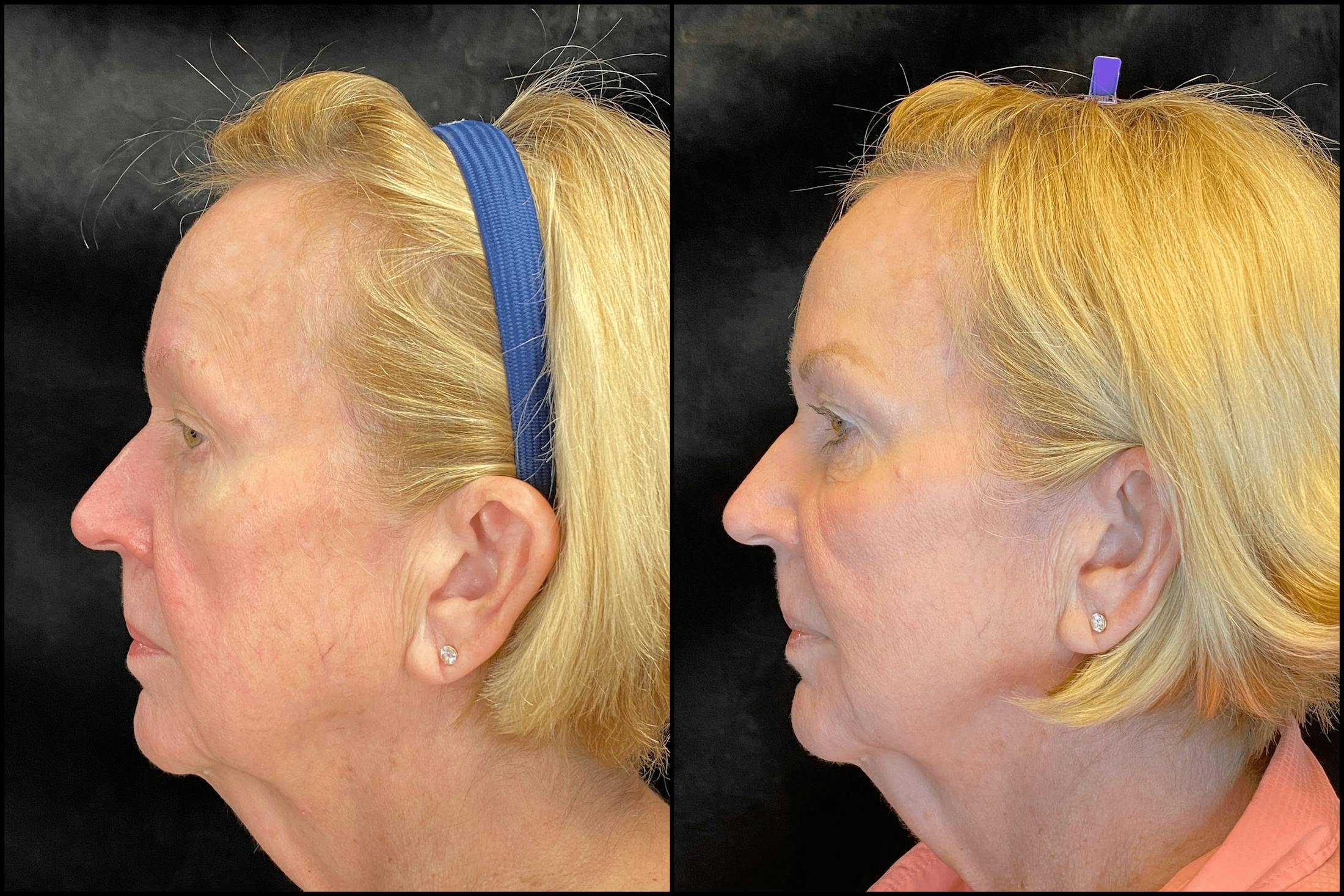 BOTOX/Dysport Before & After Gallery - Patient 79766576 - Image 3