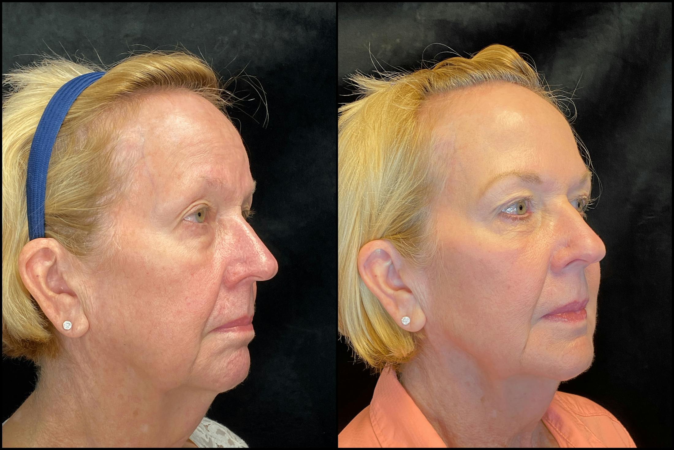 Dermal Fillers Before & After Gallery - Patient 79763242 - Image 2