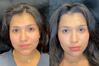 Dermal Fillers Before & After Gallery - Patient 79763244 - Image 1