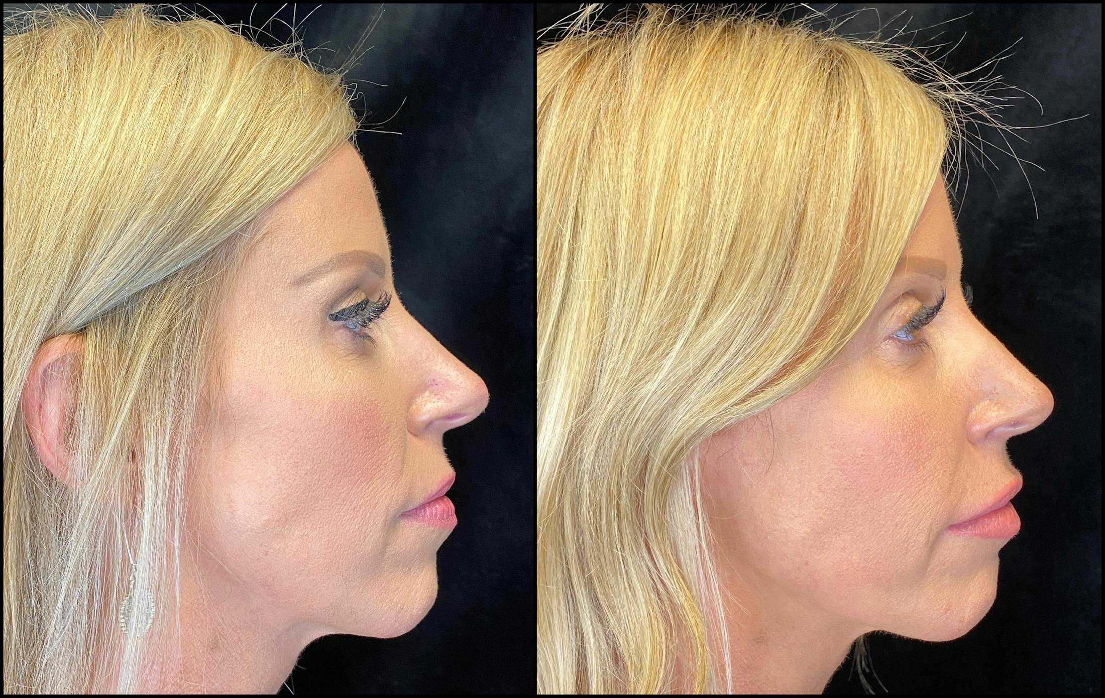 Dermal Fillers Before & After Gallery - Patient 79763551 - Image 4