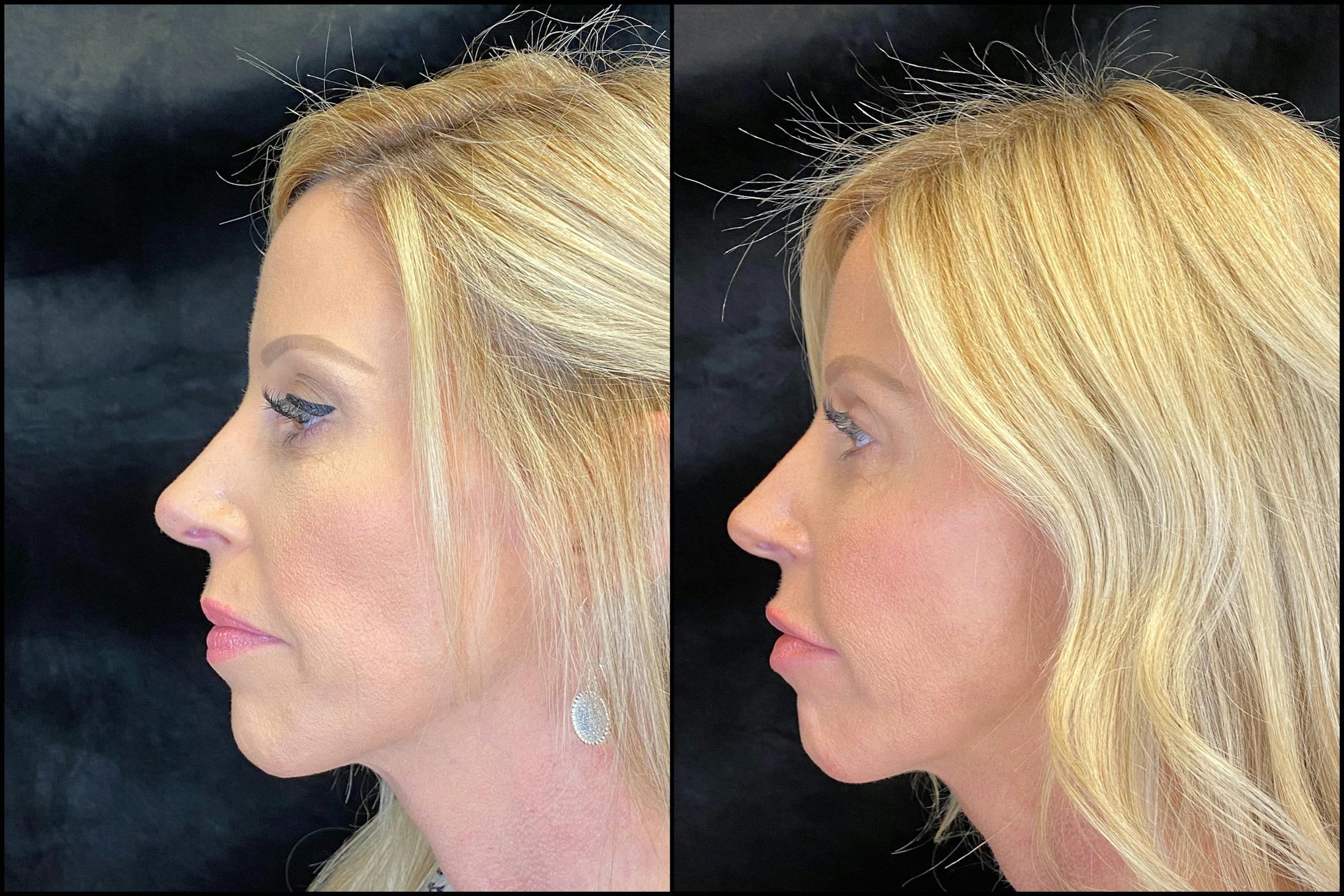 Dermal Fillers Before & After Gallery - Patient 79763551 - Image 5
