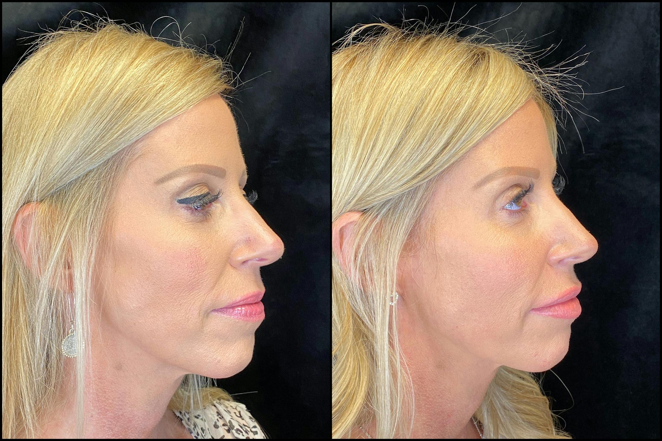Dermal Fillers Before & After Gallery - Patient 79763551 - Image 3