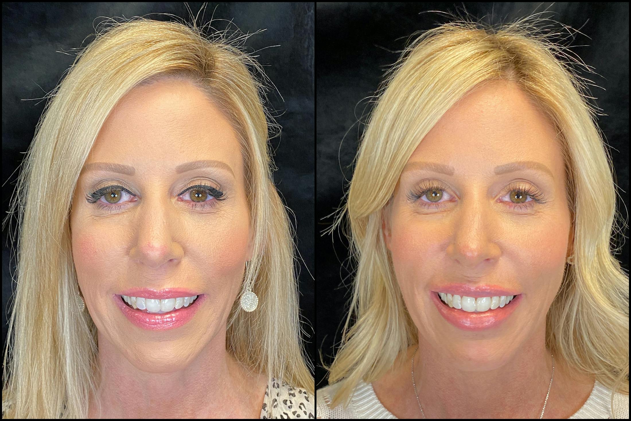 Dermal Fillers Before & After Gallery - Patient 79763551 - Image 2
