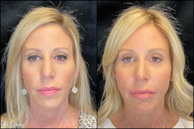 Dermal Fillers Before & After Gallery - Patient 79763551 - Image 1