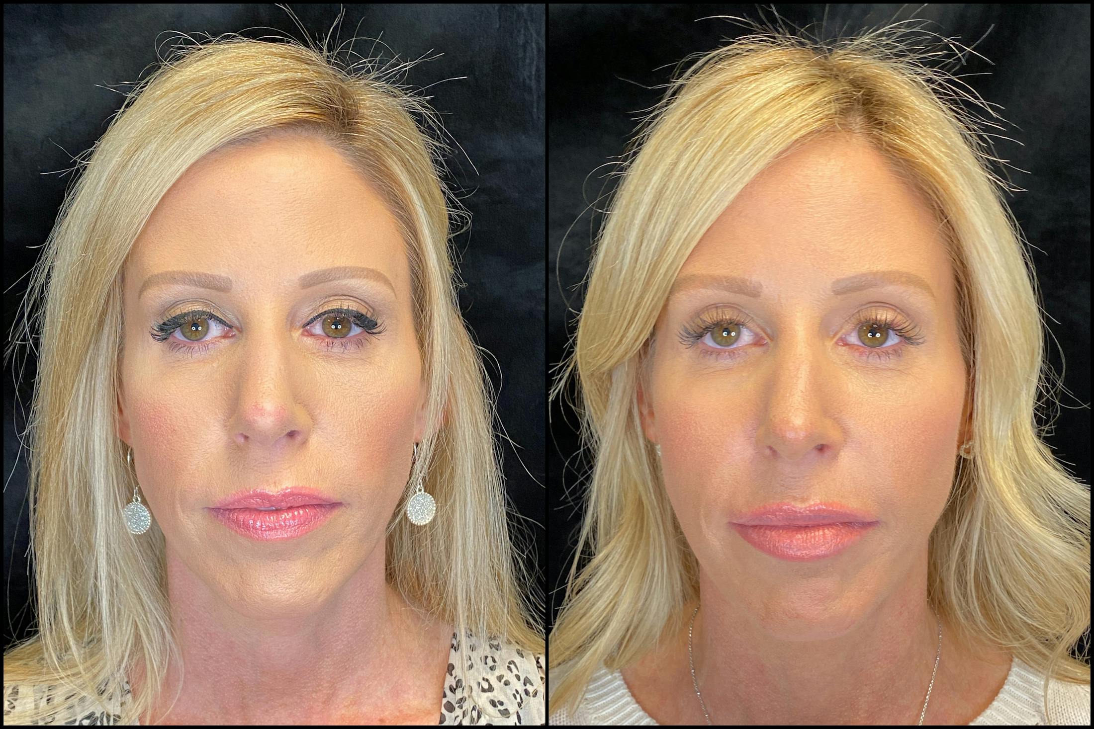 Dermal Fillers Before & After Gallery - Patient 79763551 - Image 1