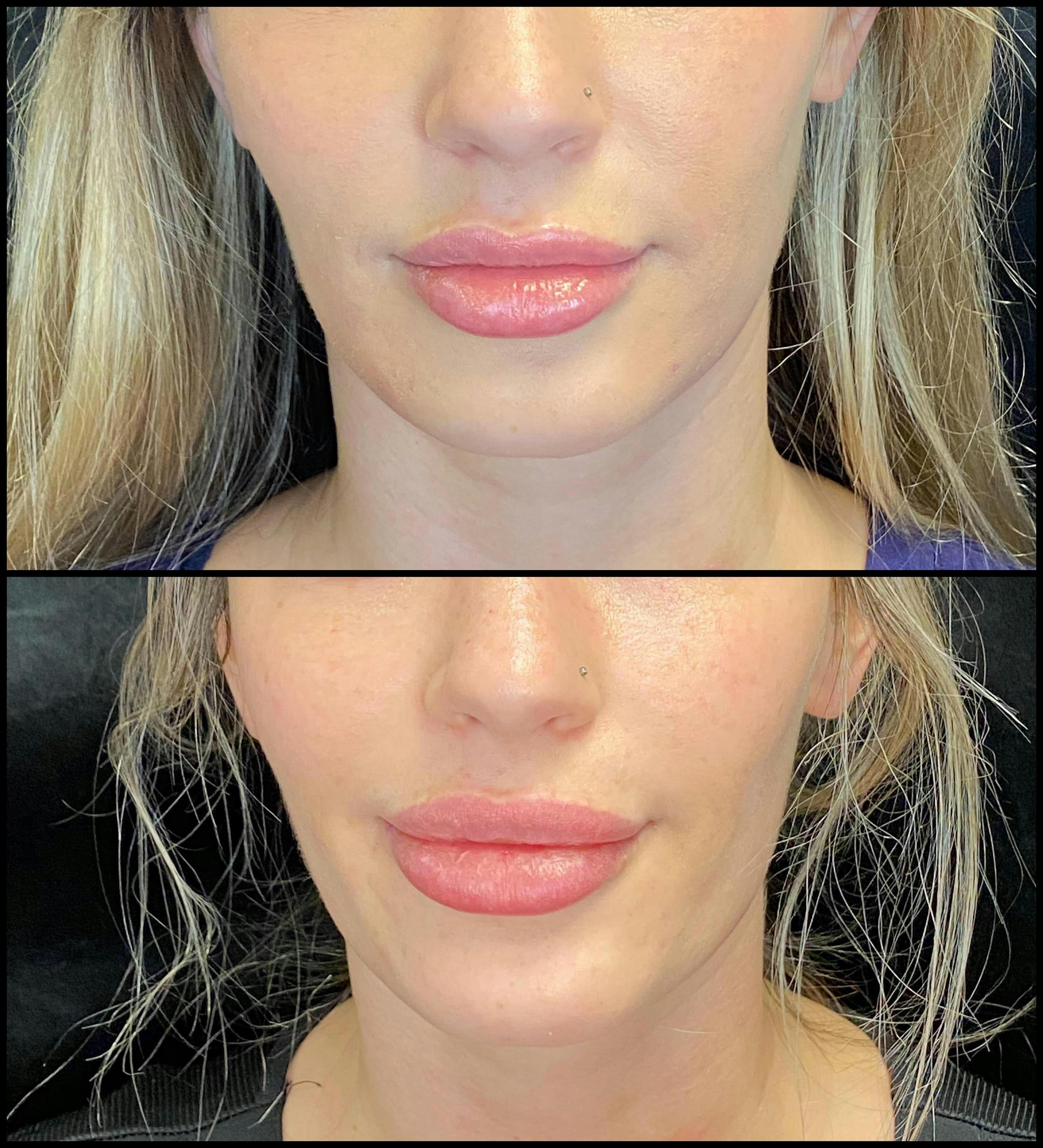 Patient 79763599 Dermal Fillers Before & After Photos Modern Women