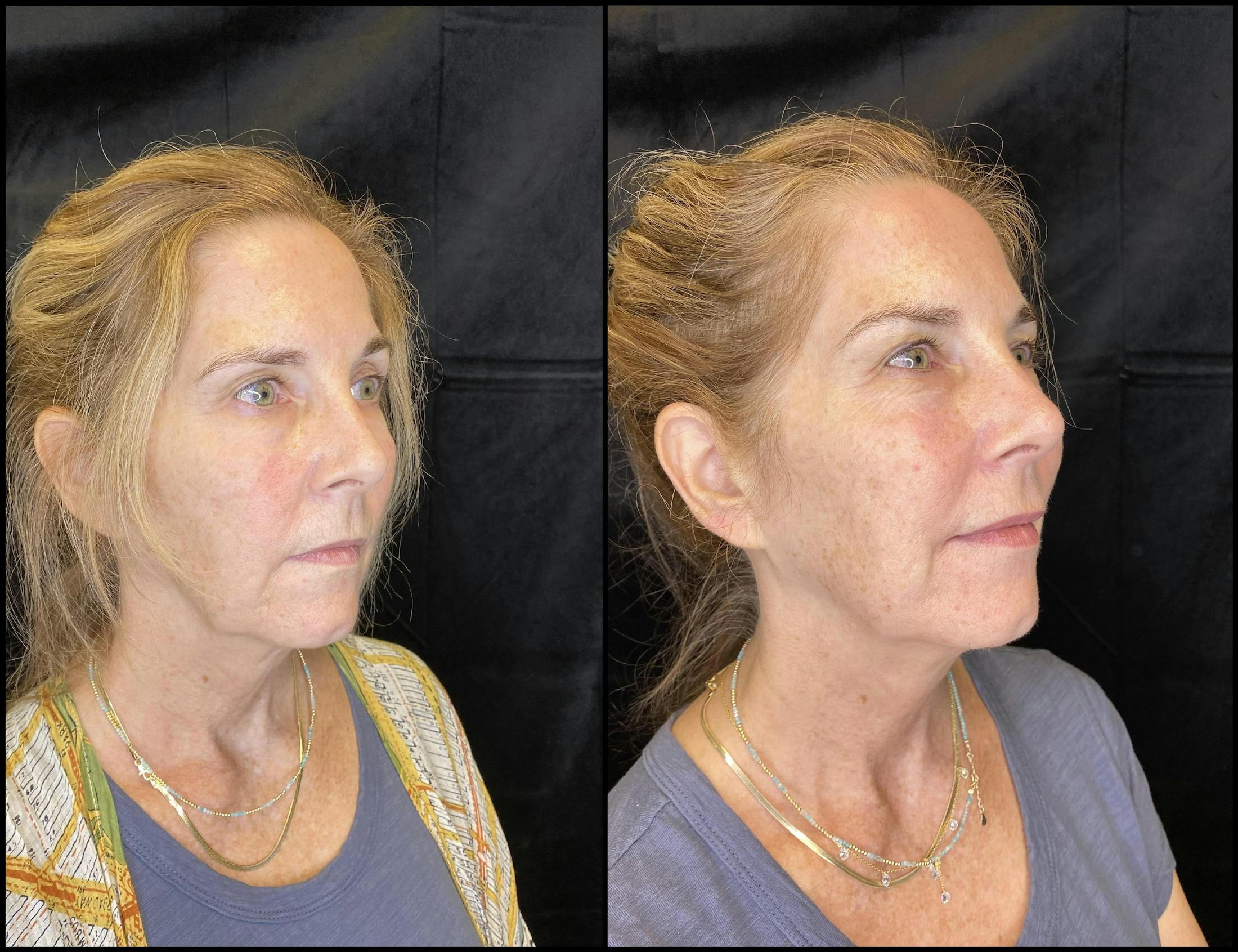 Dermal Fillers Before & After Gallery - Patient 79763715 - Image 2