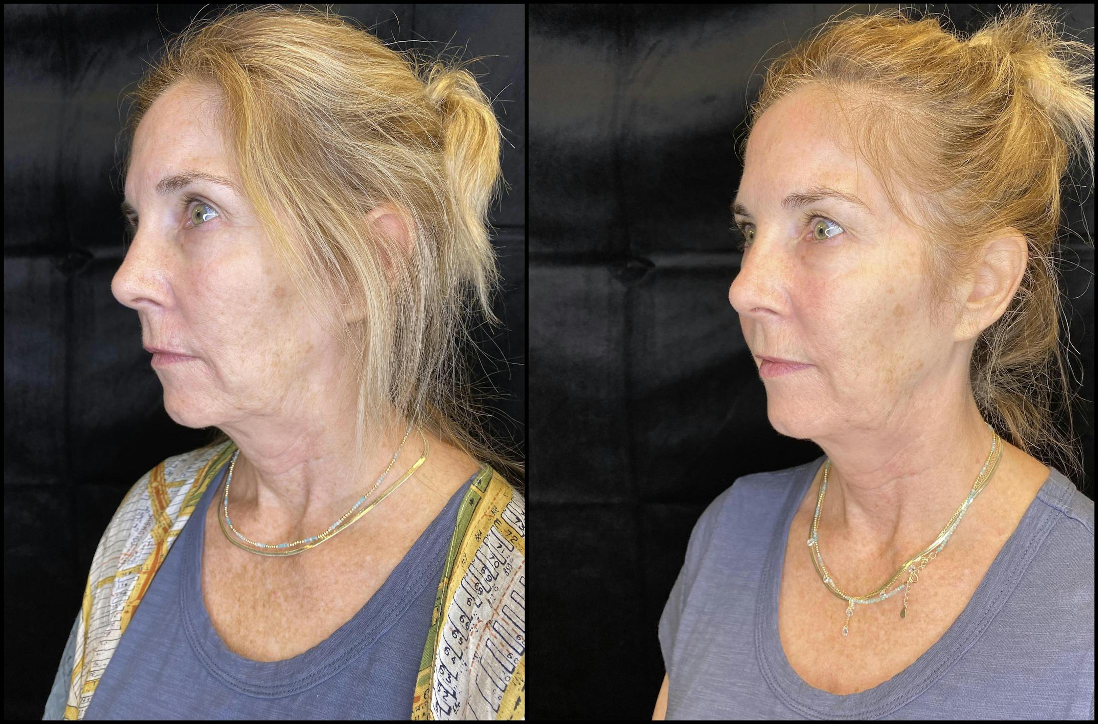 Dermal Fillers Before & After Gallery - Patient 79763715 - Image 3