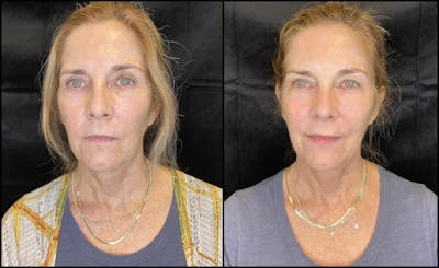 Dermal Fillers Before & After Gallery - Patient 79763715 - Image 1