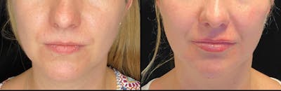 Dermal Fillers Before & After Gallery - Patient 79763793 - Image 1
