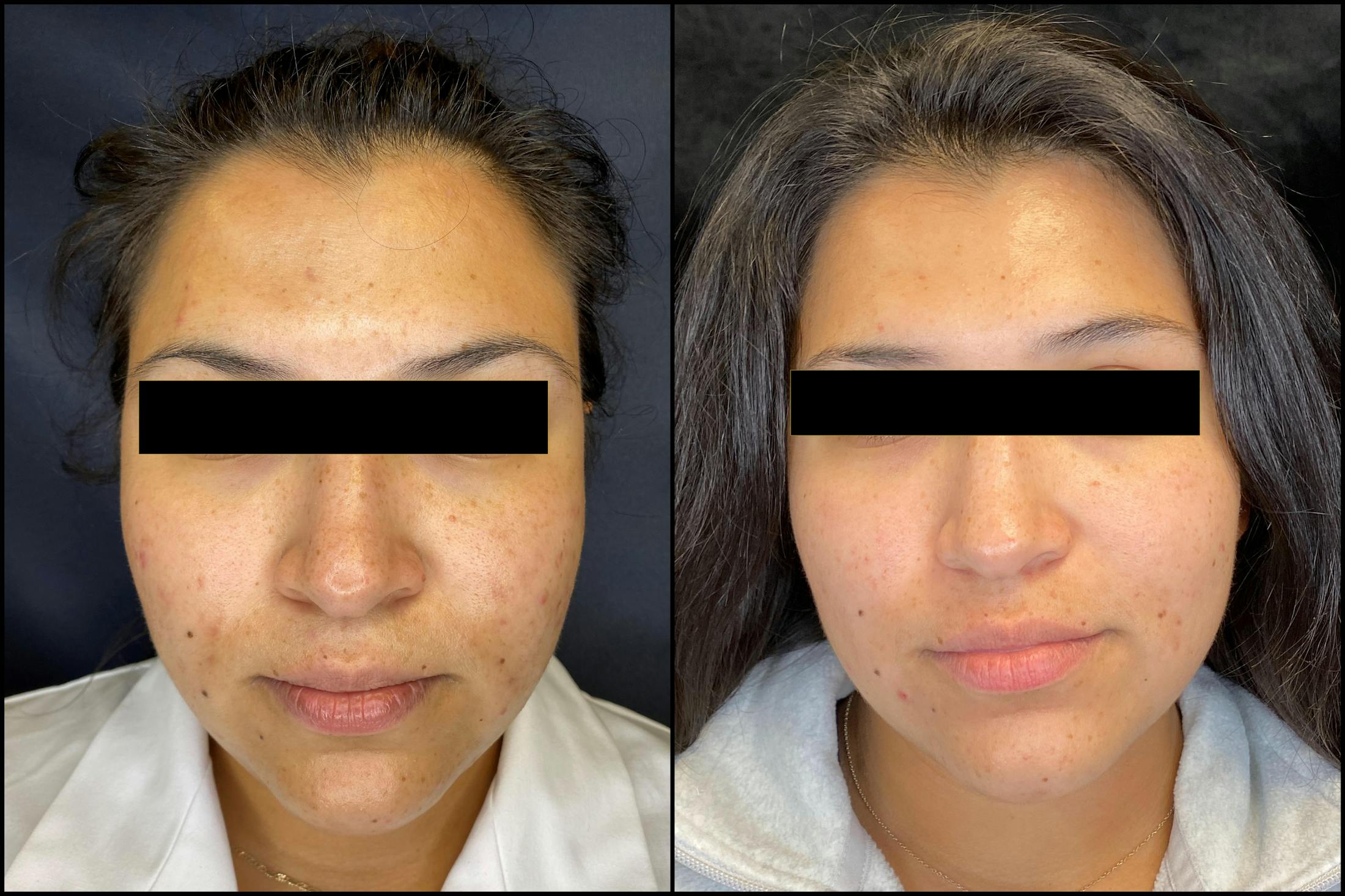 Chemical Peels Before & After Gallery - Patient 121120903 - Image 1