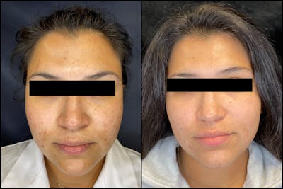 Chemical Peels Before & After Gallery - Patient 121120903 - Image 1