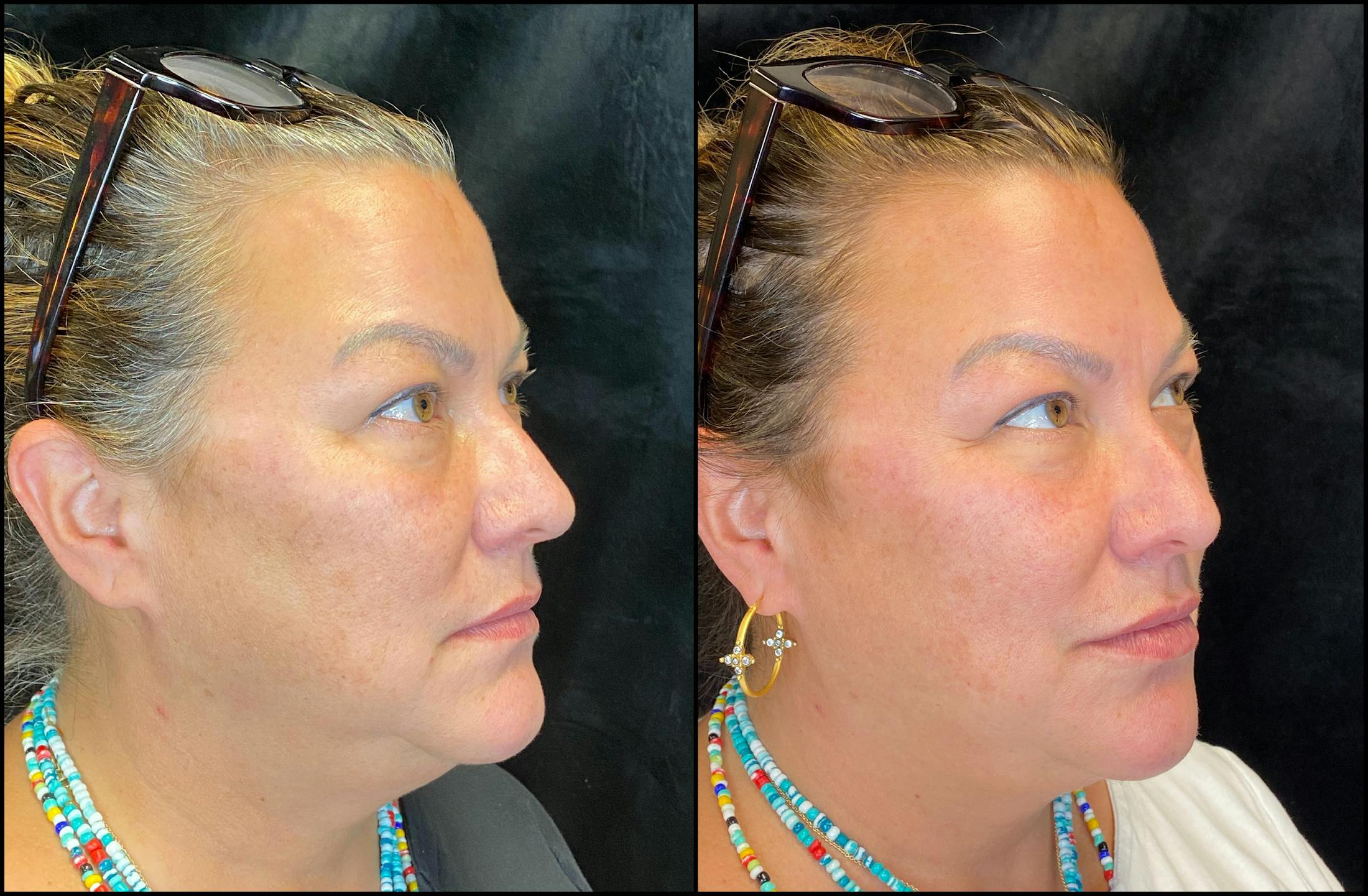 Dermal Fillers Before & After Gallery - Patient 79764455 - Image 2