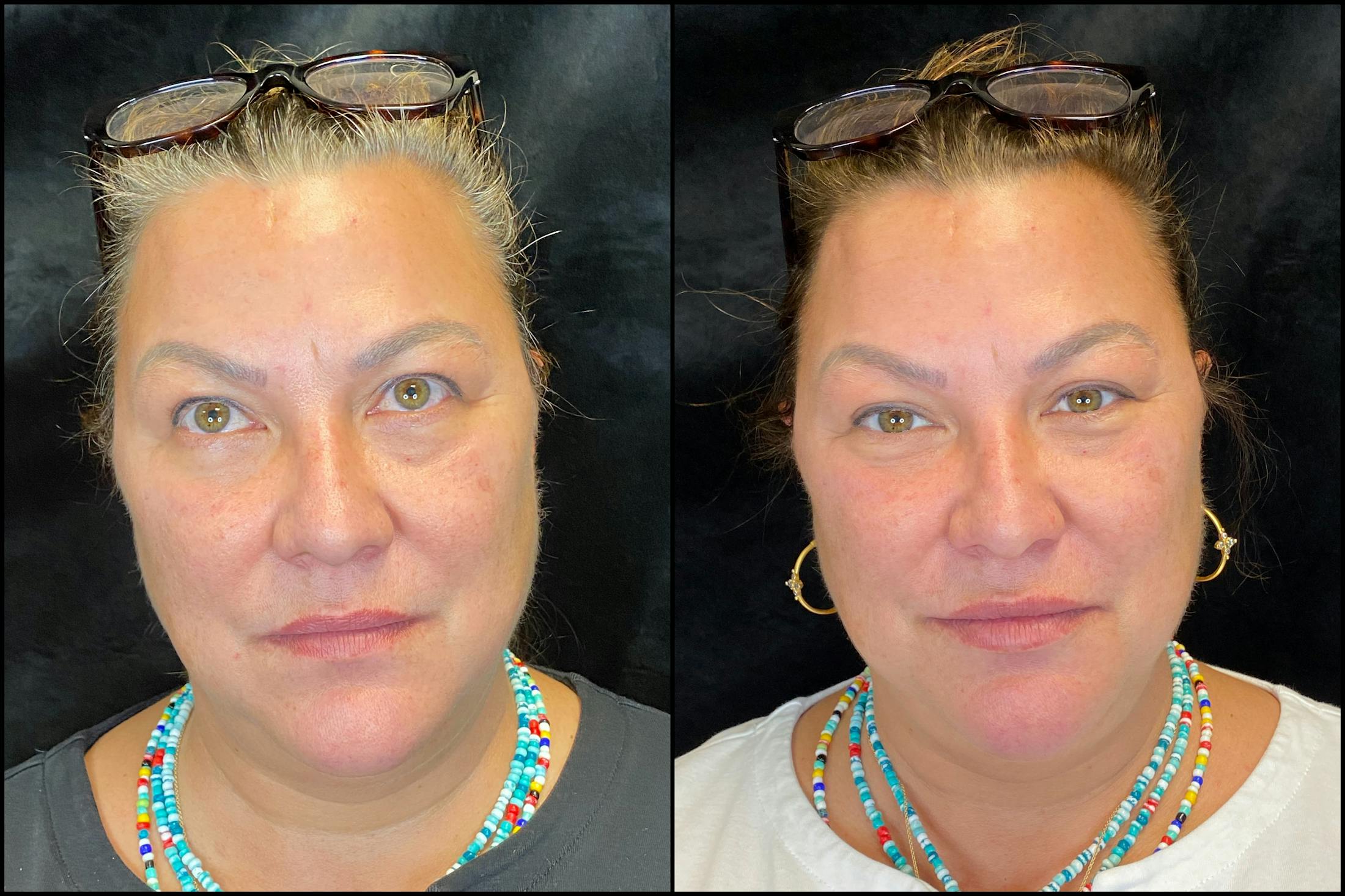 Dermal Fillers Before & After Gallery - Patient 79764455 - Image 1