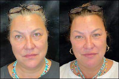 BOTOX/Dysport Before & After Gallery - Patient 83697443 - Image 1