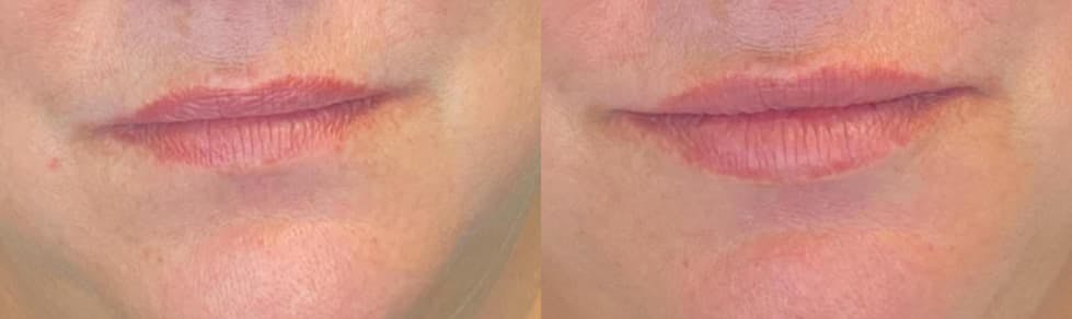 Dermal Fillers Before & After Gallery - Patient 79764455 - Image 4