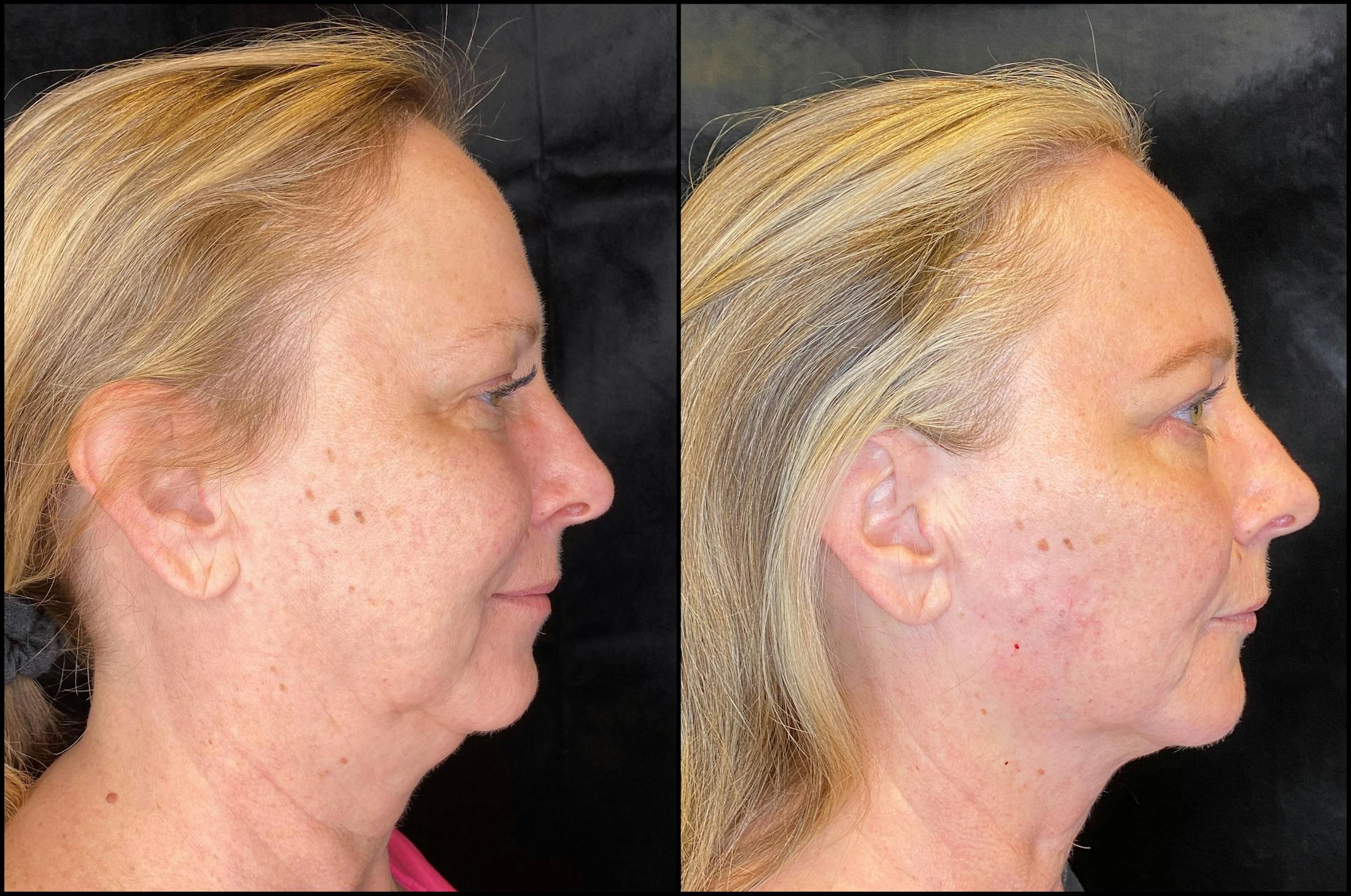 Dermal Fillers Before & After Gallery - Patient 79766216 - Image 3
