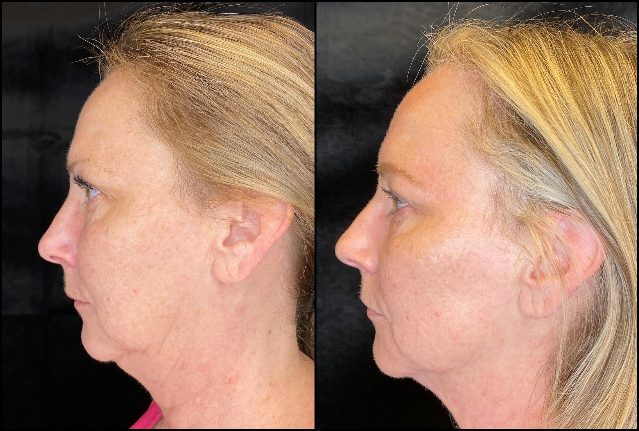 Dermal Fillers Before & After Gallery - Patient 79766216 - Image 5