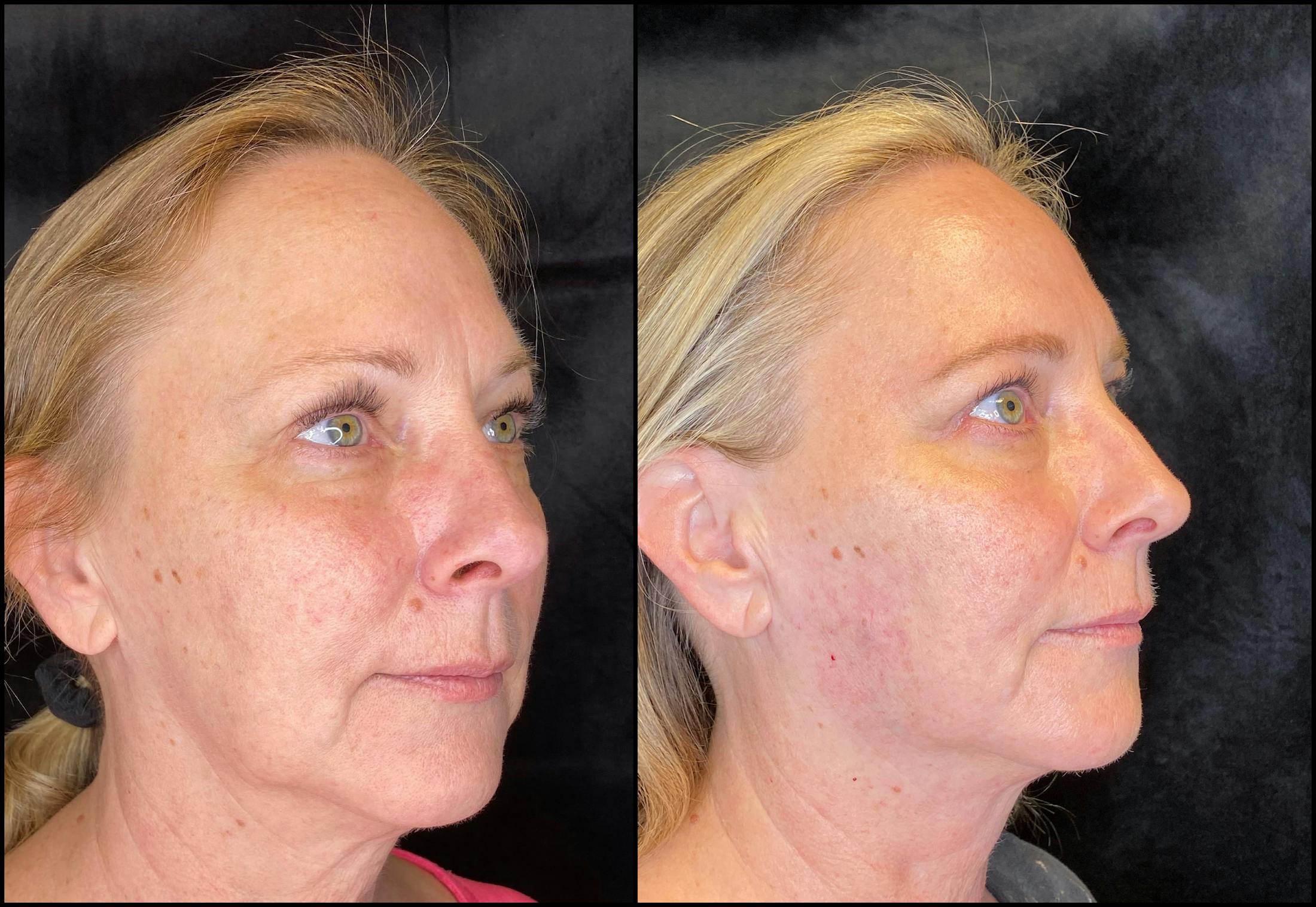 Dermal Fillers Before & After Gallery - Patient 79766216 - Image 2