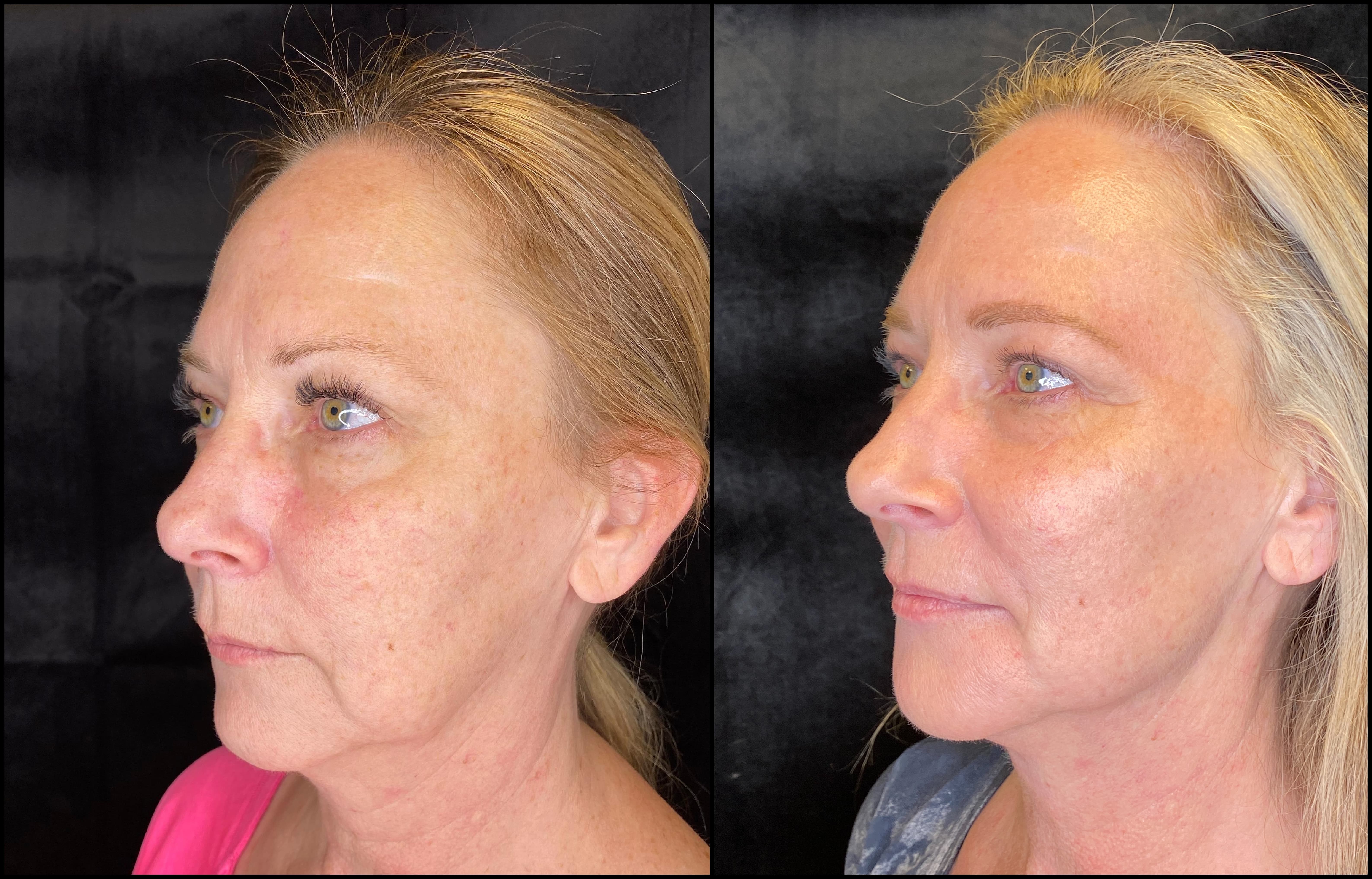 Patient 79767256 Evoke Before & After Photos Modern Women's Health