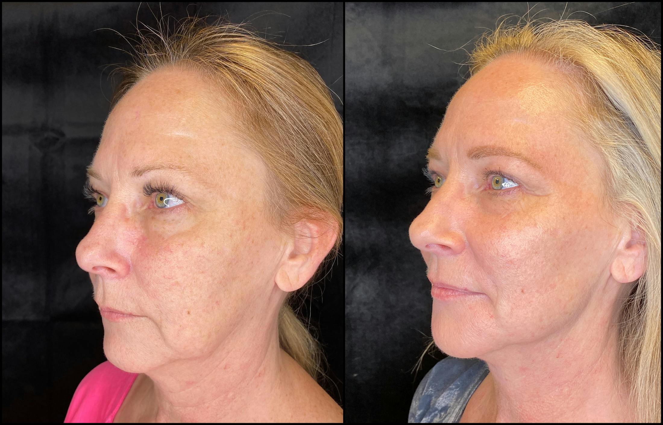 Morpheus8 Before & After Gallery - Patient 79766588 - Image 2