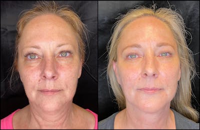 Dermal Fillers Before & After Gallery - Patient 79766216 - Image 1
