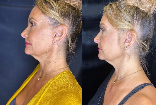 BOTOX/Dysport Before & After Gallery - Patient 79767386 - Image 3