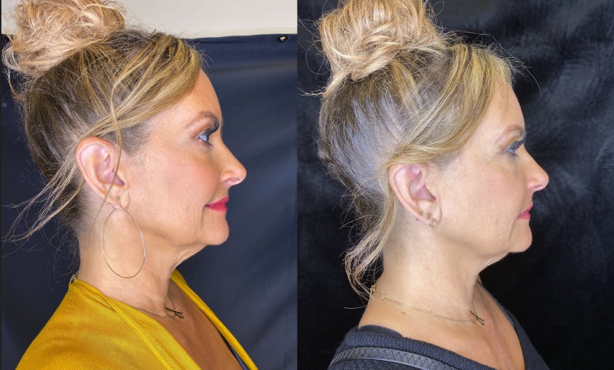 BOTOX/Dysport Before & After Gallery - Patient 79767386 - Image 2