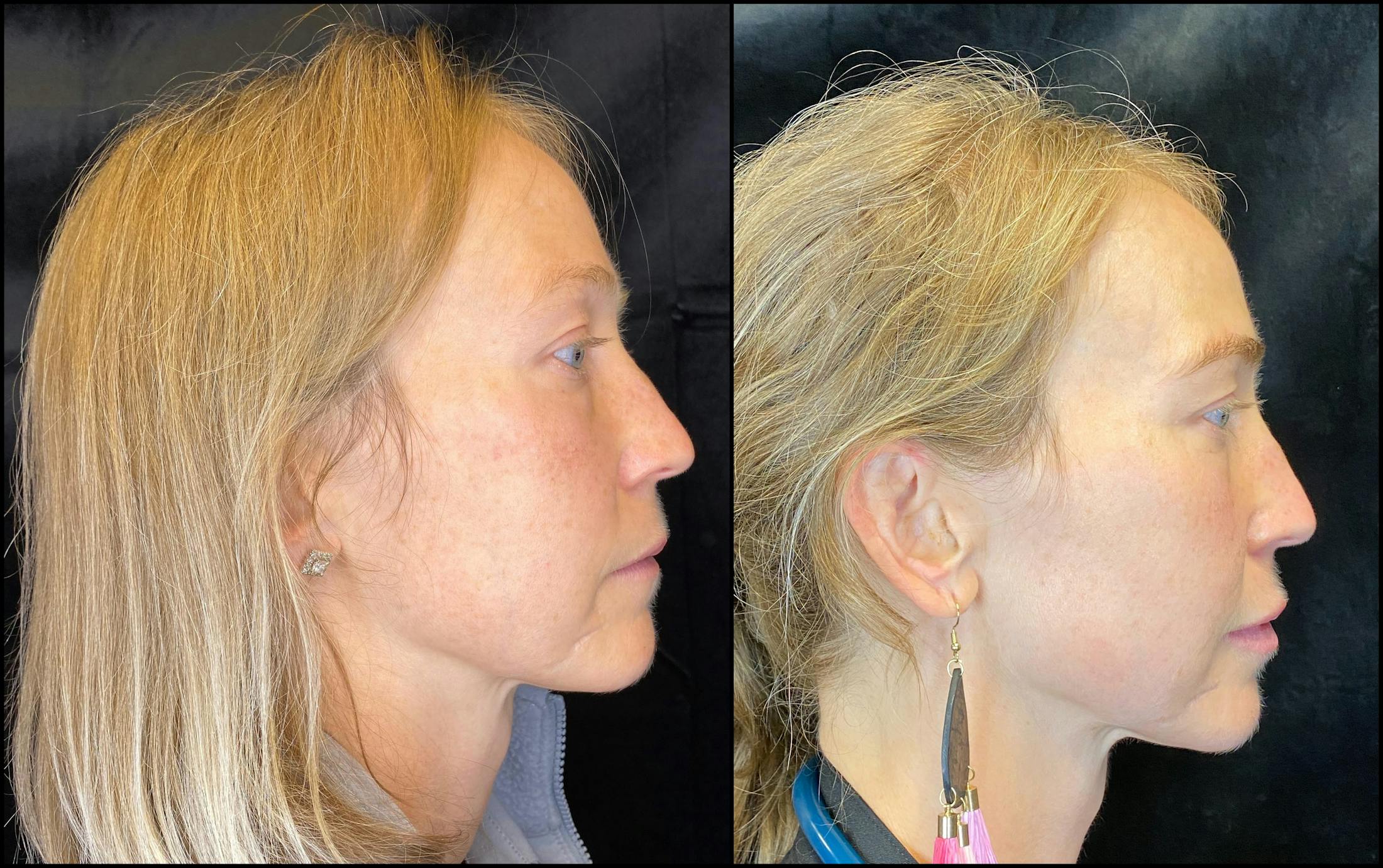 IPL for Face Before & After Gallery - Patient 83697533 - Image 5