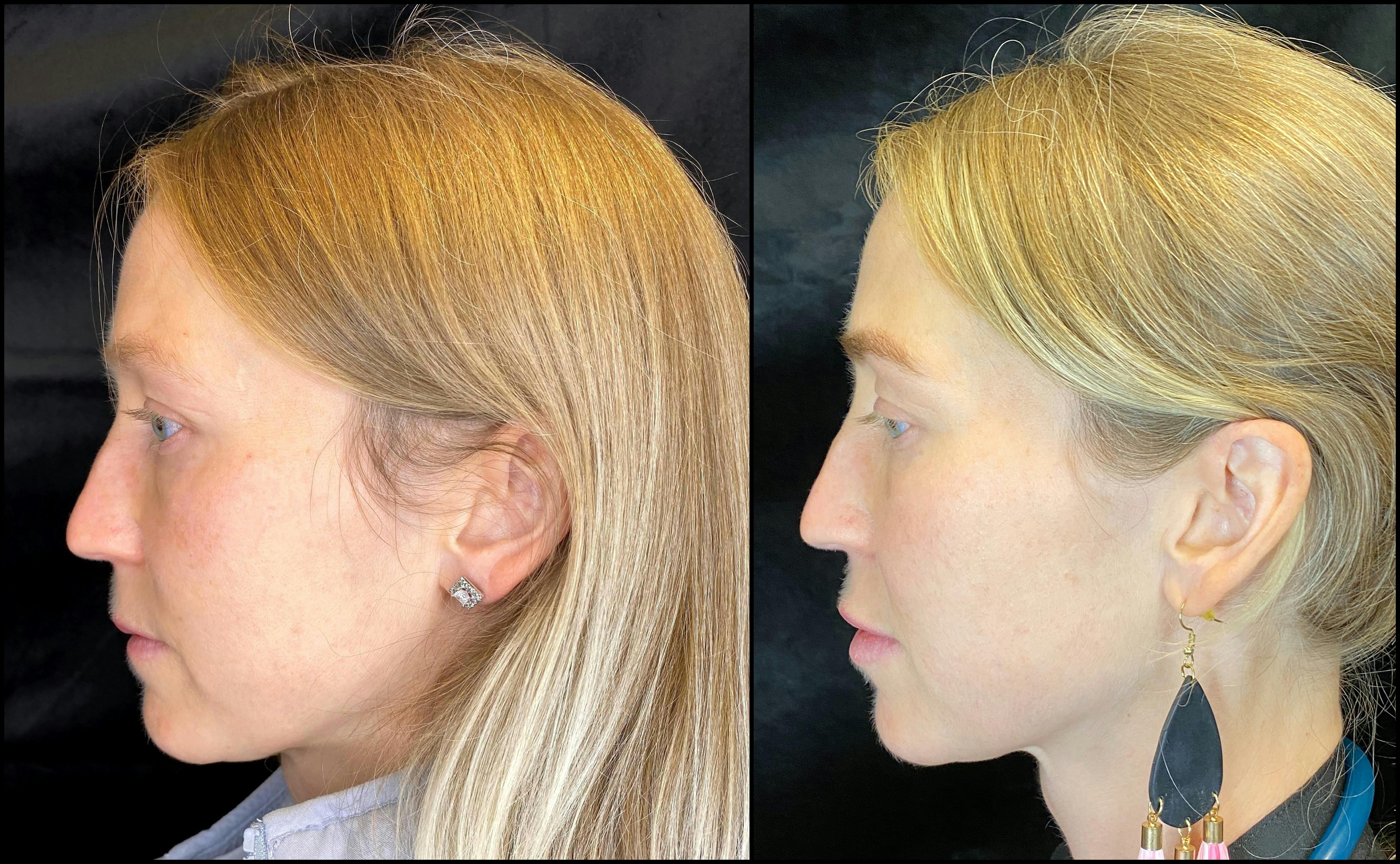 IPL Photofacial with Lemecca Gallery - Patient 83697533 - Image 2