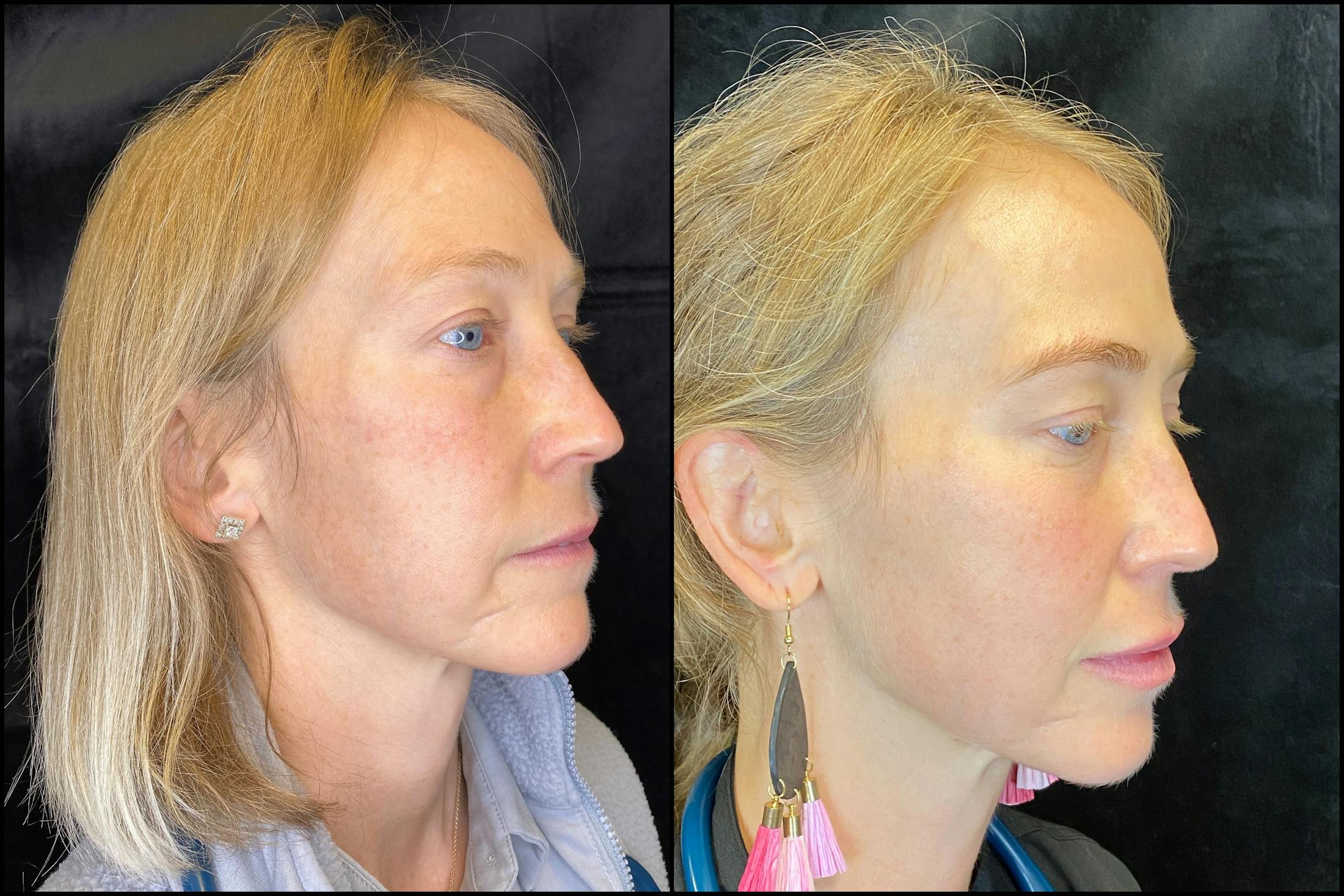 IPL for Face Before & After Gallery - Patient 83697533 - Image 4