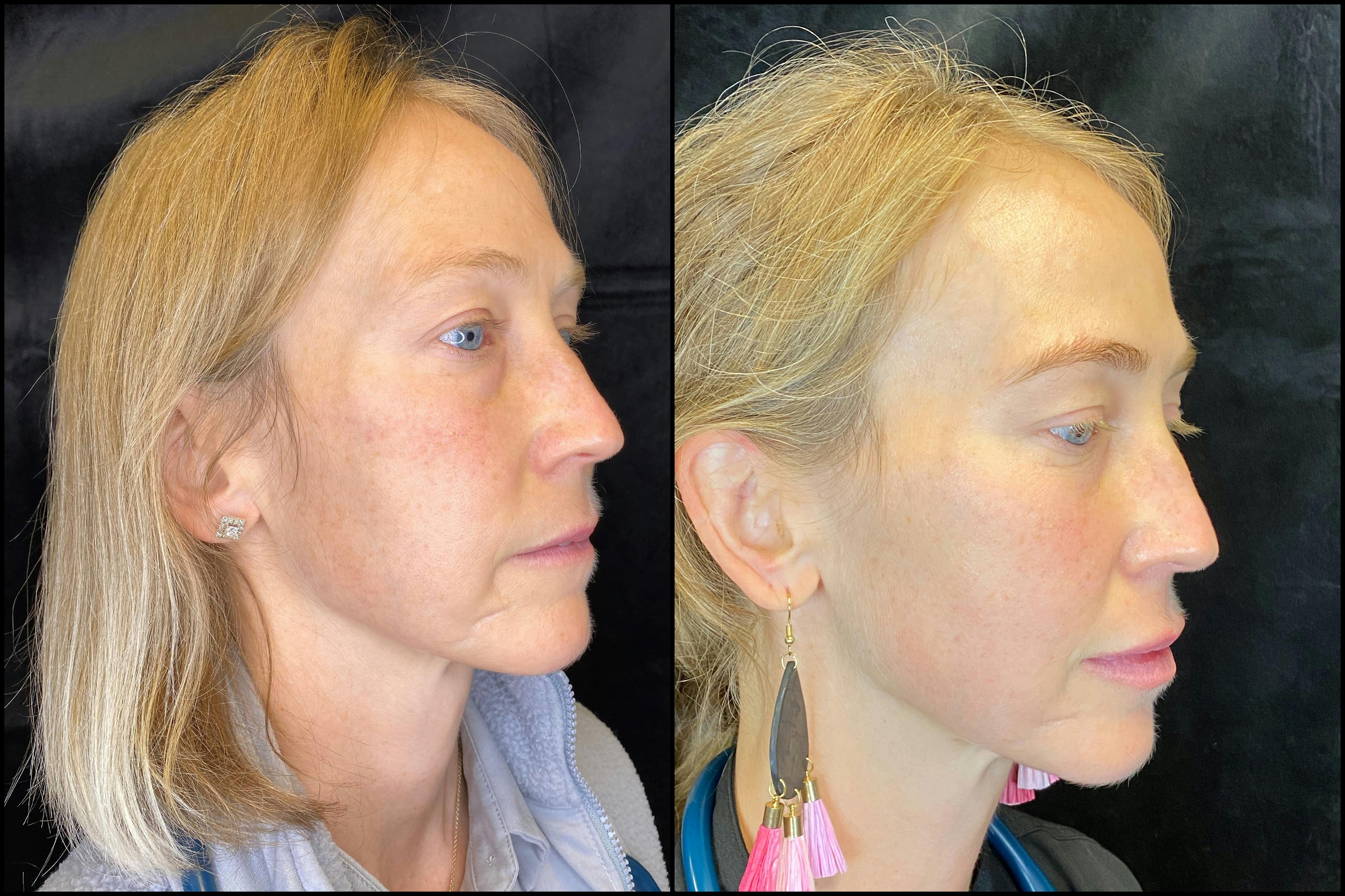 IPL Photofacial with Lemecca Gallery - Patient 83697533 - Image 4
