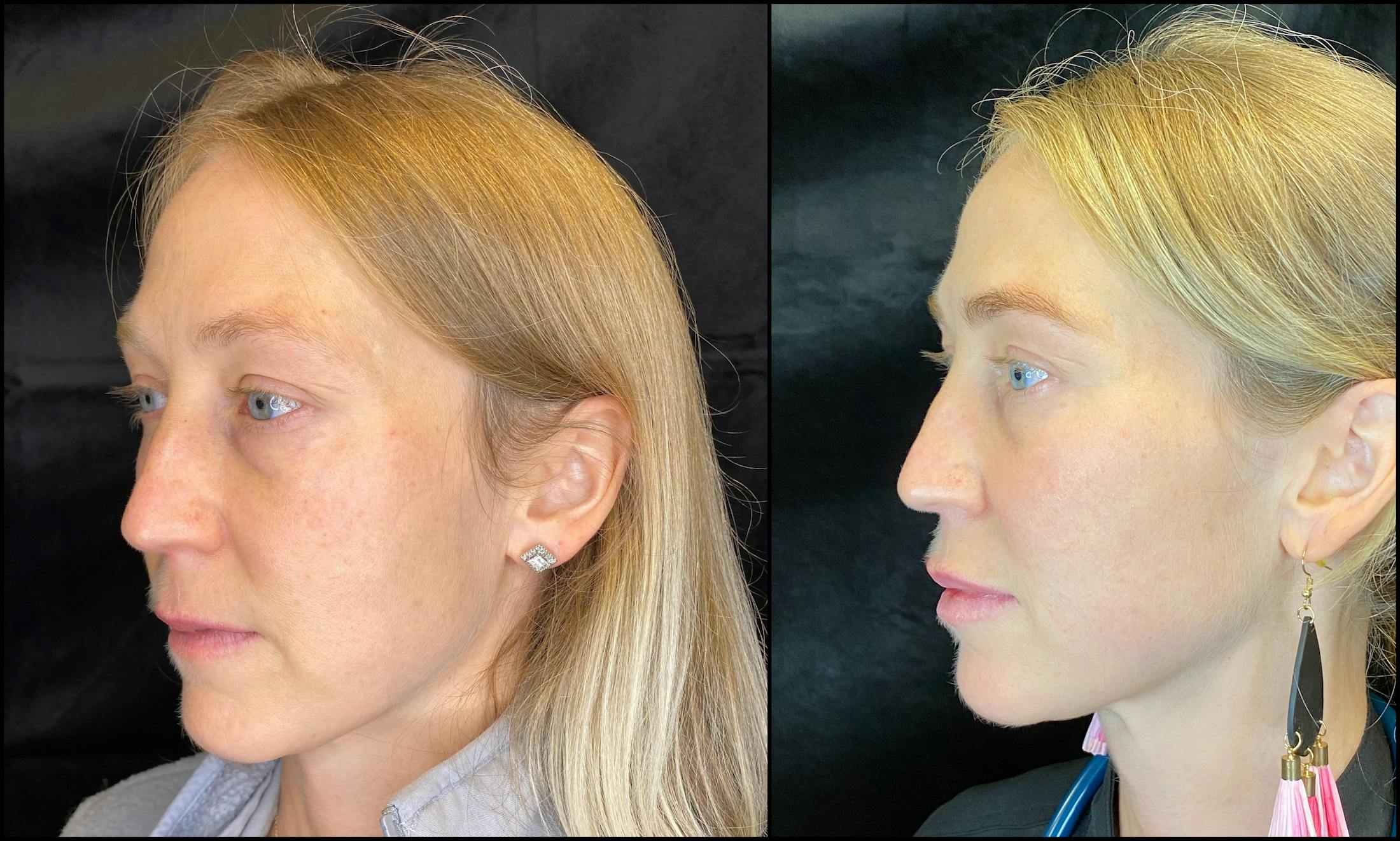 IPL for Face Before & After Gallery - Patient 83697533 - Image 3