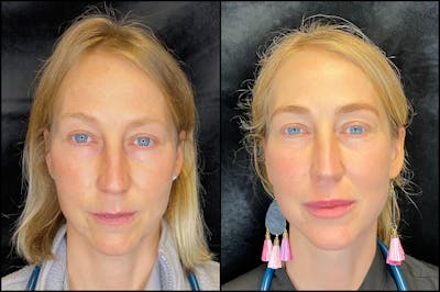 Morpheus8 Before & After Gallery - Patient 79767179 - Image 1