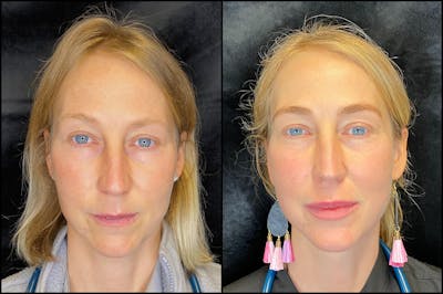 BOTOX/Dysport Before & After Gallery - Patient 83697325 - Image 1