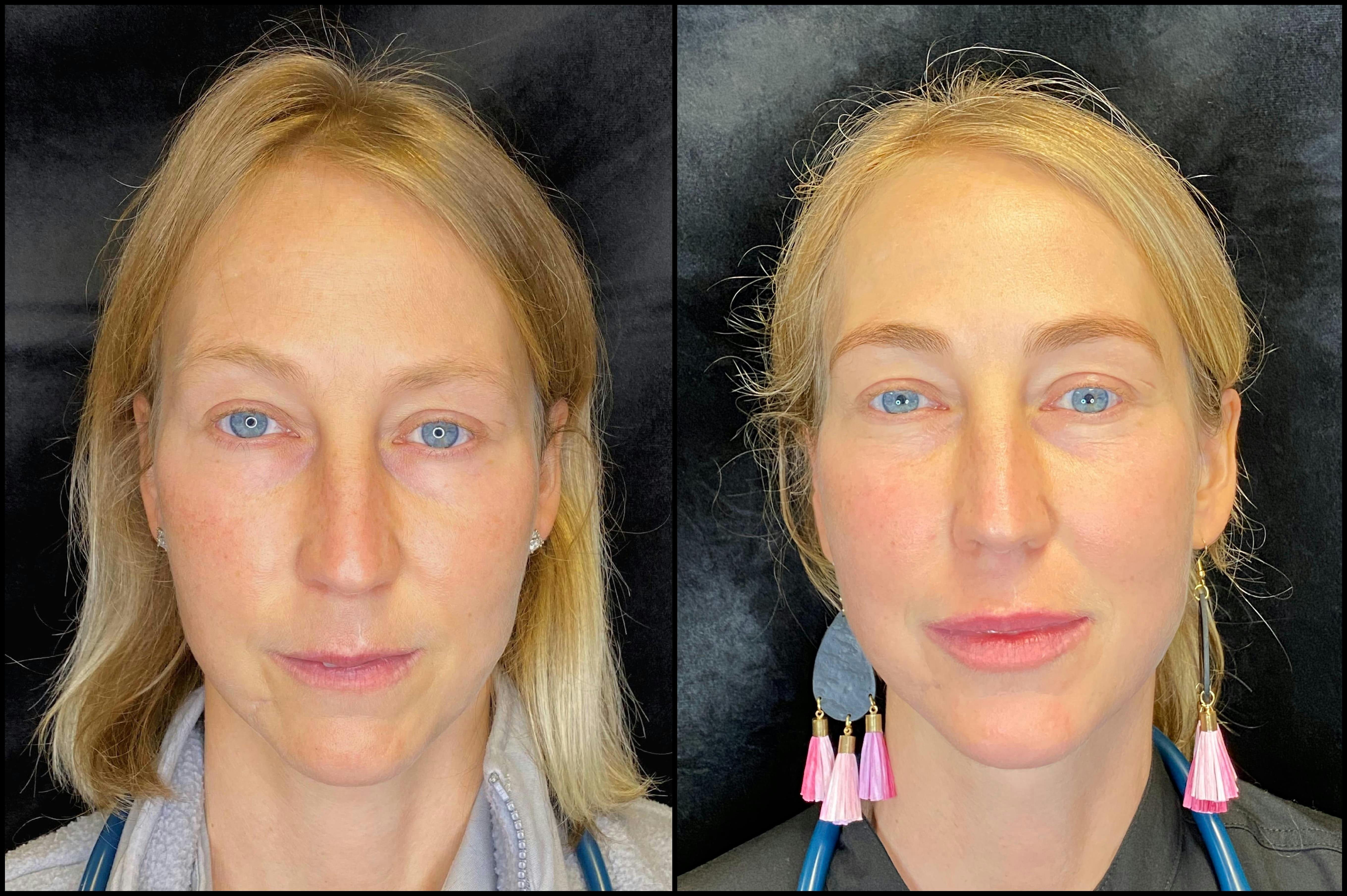IPL Photofacial with Lemecca Gallery - Patient 83697533 - Image 1